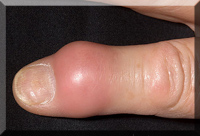 Gout in finger